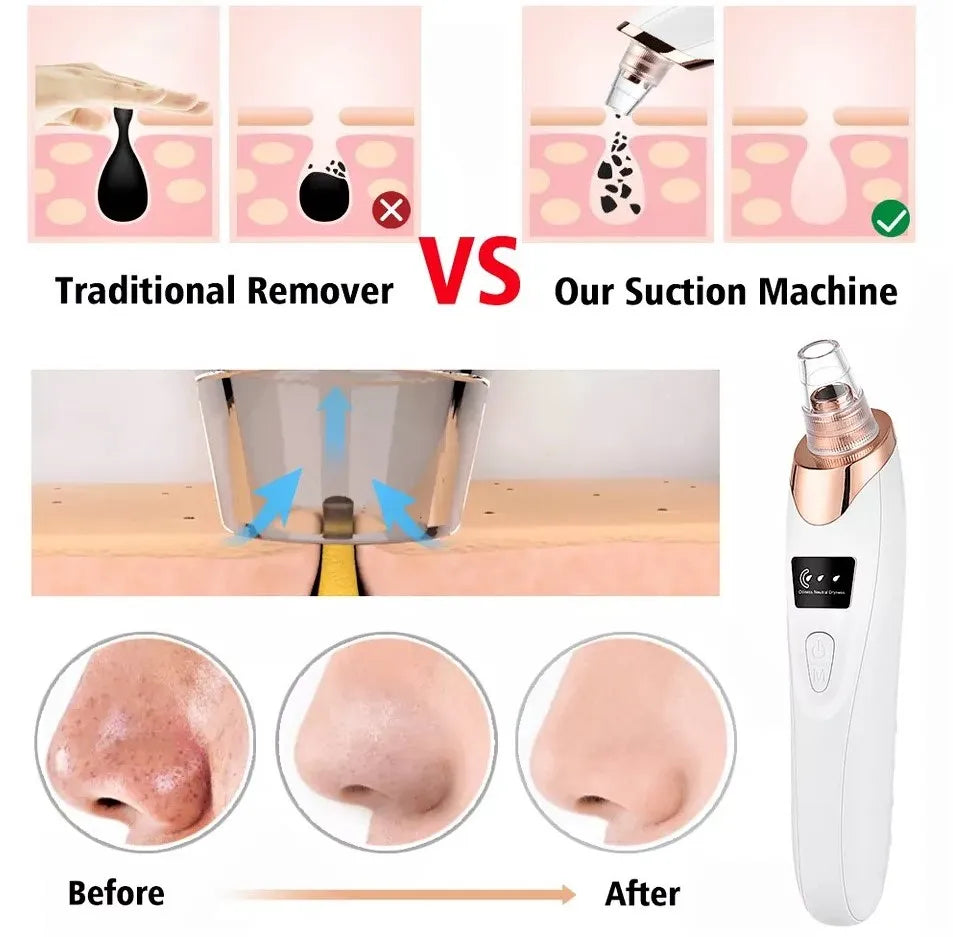 5-in-1 Facial Blackhead Remover | Rechargeable Pore Vacuum with 5 Interchangeable Heads
